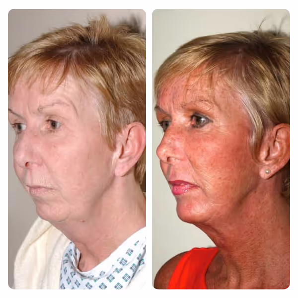 Neck Lift in Turkey
